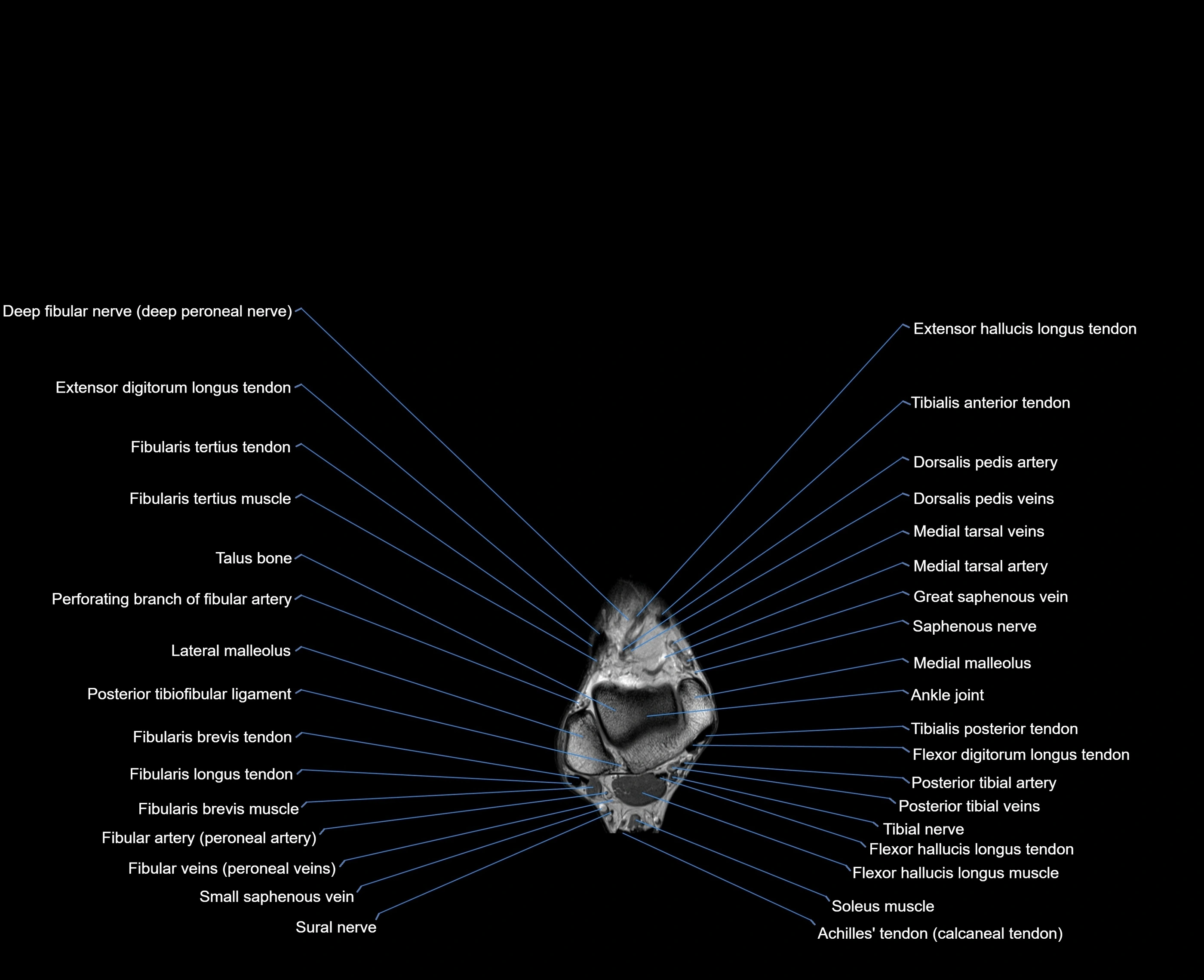 MRI foot coronal cross sectional anatomy 3T  radiology  image-img-00001-00006.webp